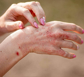 Atopic Dermatitis (Eczema)