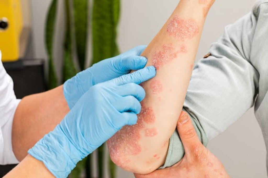 The Link Between Allergies and Eczema: How to Manage Both Conditions